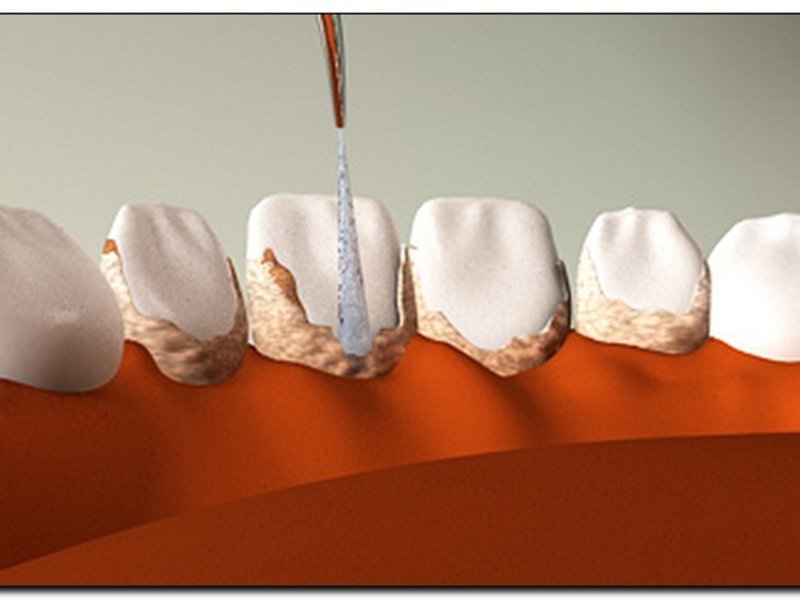 Как избавиться от зубного камня ультразвуком