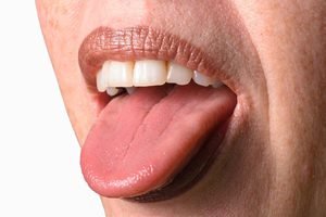 Причины отпечаток от зубов на языке