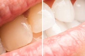 Как отбеливают зубы