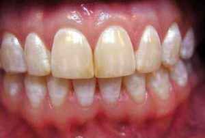 После отбеливания могут появиться белые пятна на зубах