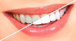 Профессиональное отбеливание зубов - разные методы