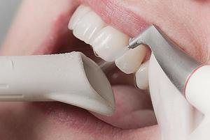 Что даёт чистка зубов оборудованием air flow, что это такое?