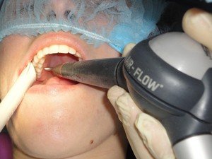 Отбеливание зубов Air Flow - фото процесса