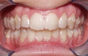 Как элайнеры выравнивают зубы