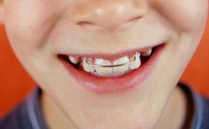 Особенности использования пластин для зубов