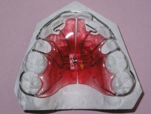 Цена пластин для выравнивания зубов