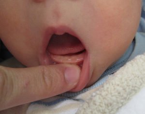 Как облегчить боль при прорезывании зубов у младенцев
