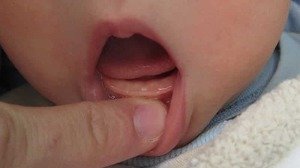 Зубы новорожденных