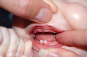 Прорезывание зубов у ребенка: как пережить, способы и советы