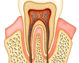 В зубе под пломбой болит нерв: причины