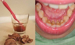 Народные методы борьбы с зубным камнем