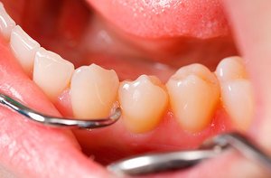 Почему возникают зубные камня