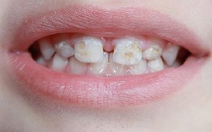 Симптомы кариеса молочных зубов