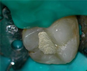 Временные пломбы с лекарствами - лечение зубов.