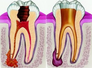 Периодонтит и киста зуба как осложнения кариеса