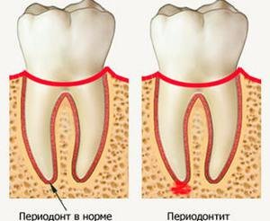 Как лечить периодонтит зуба