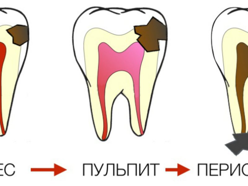 Процесс лечения пораженного зуба