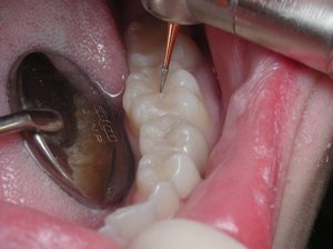 Какие есть пломбы на зубы