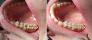 Пломбировка зубов в стоматологическом кабинете