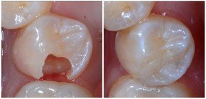 Как проводится процедура пломбирования зубов