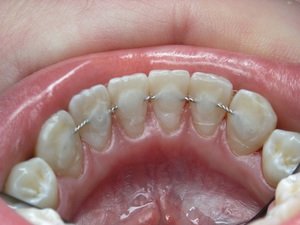 Как делается шинирование зубов