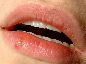 Причины появления болячек на губах