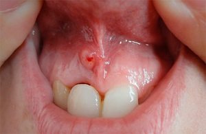 Описание патологии воспаления нерва зуба