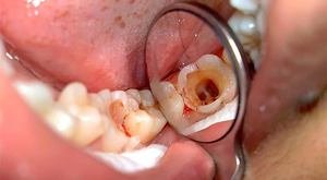 Лечение пульпита может проводить только стоматолог