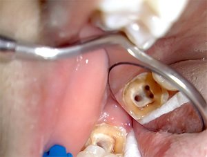 Пульпит трехканального зуба - особенности лечения