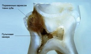 Кариес и пульпит зуба - в чем разница