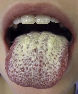Белый налет на языке и разные болезни - на что обращать внимание?