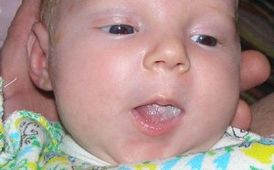 Белый налет у ребенка на языке - один из признаков простудных заболеваний