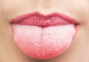 Здоровый язык имеет розовый оттенок без белых или желтоватых вариантов налета.