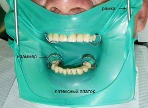 Что такое коффердам, использование такой защиты в стоматологии