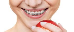 Стоматологи рекомендуют ношение брекетов для того, чтобы выровнять зубы