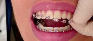 Привлекательные брекеты на зубах - современные решения