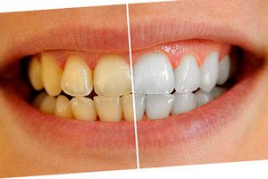 Как осветлить поверхность зубов
