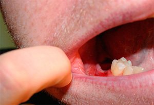 Причины и осложнения незаживающей лунки после удаления зуба мудрости