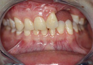 Причины и симптомы альвеолита после удаления зуба