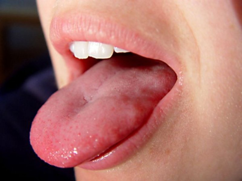 Почему болит язык
