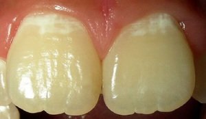 Появление гиперестезии из-за кариеса зубов