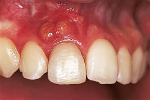 Описание патологии гранулёмы зуба