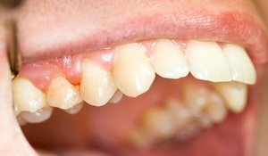 Причины образования гранулёмы зуба