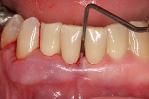 Процесс образования гранулёмы зуба и её формы