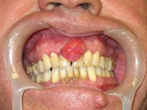 Описание возможных осложнений нелеченной гранулёмы зуба