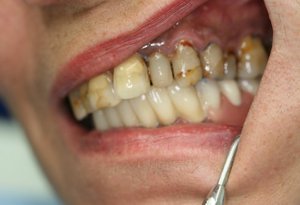 Стадия заболевания зубов