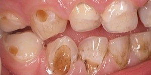 Испорченные зубы