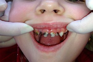 Разрушение зубов