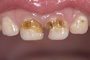 Гниение зубов