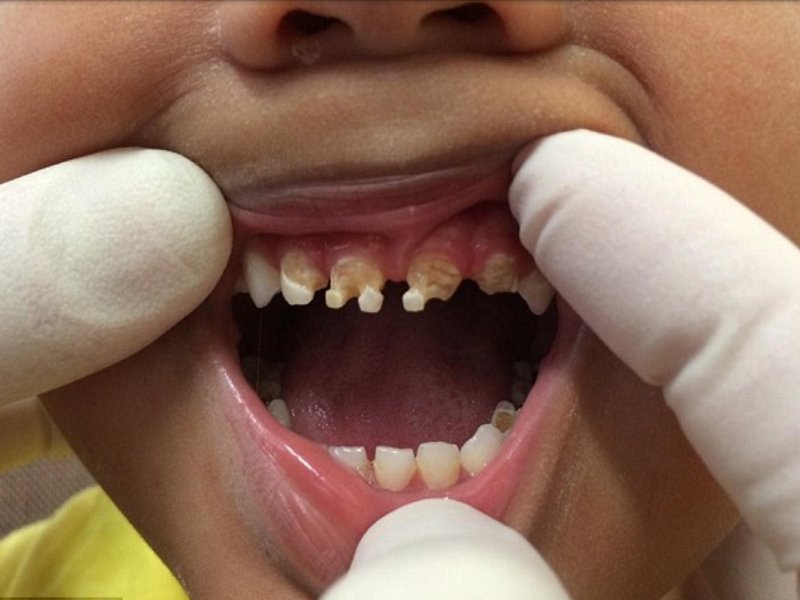 Возможные причины гниения зубов